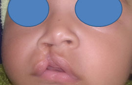 Cleft Lip And Palate Correction In Gurgaon