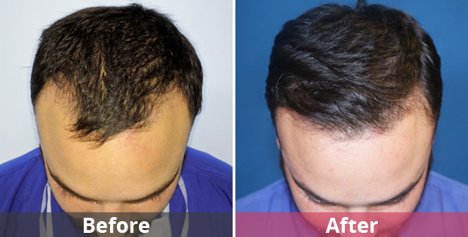 What are the reasons for choosing the best hair transplant surgeon in gurgaon?